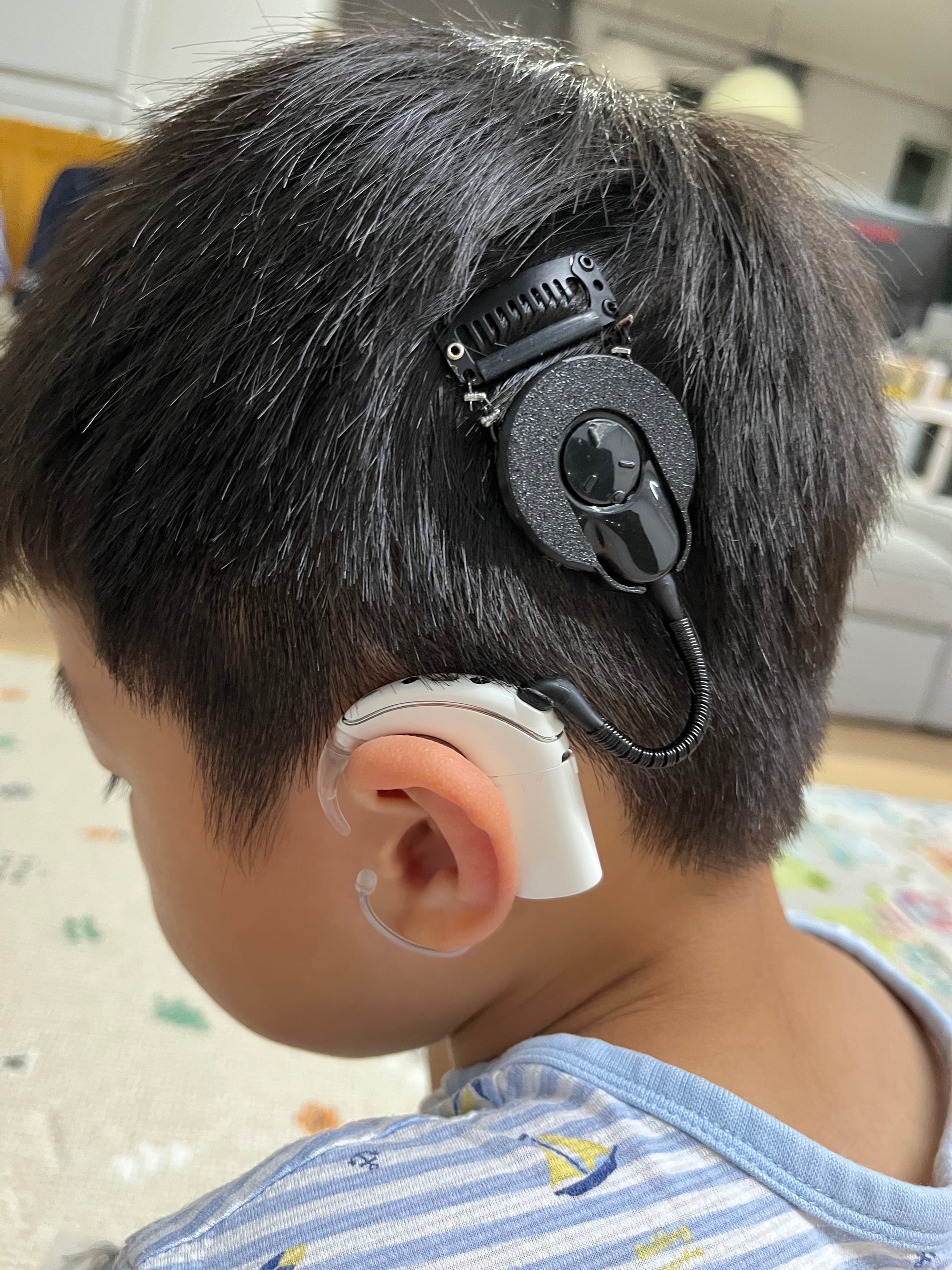 Cochlear Implant coil case for N7 and N8
